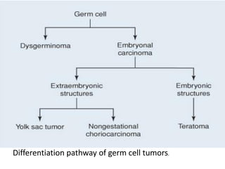 Differentiation pathway of germ cell tumors.
 