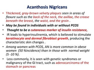 Acanthosis Nigricans
• Thickened, gray-brown velvety plaques seen in areas of
flexure such as the back of the neck, the axillae, the crease
beneath the breast, the waist, and the groin .
• May be found in individuals with or without PCOS
• Thought to be a cutaneous marker of insulin resistance,
• IR leads to hyperinsulinemia, which is believed to stimulate
keratinocyte and dermal fibroblast growth, producing the
characteristic skin changes .
• Among women with PCOS, AN is more common in obese
women (50 %incidence) than in those with normal weight
(5 -10 %).
• Less commonly, it is seen with genetic syndromes or
malignancy of the GI tract, such as adenocarcinoma of the
stomach or pancreas
 