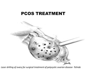 PCOS TREATMENT
Laser drilling of ovary for surgical treatment of polycystic ovarian disease- Telinde
 