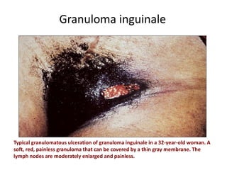 Granuloma inguinale
Typical granulomatous ulceration of granuloma inguinale in a 32-year-old woman. A
soft, red, painless granuloma that can be covered by a thin gray membrane. The
lymph nodes are moderately enlarged and painless.
 