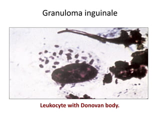 Granuloma inguinale
Leukocyte with Donovan body.
 