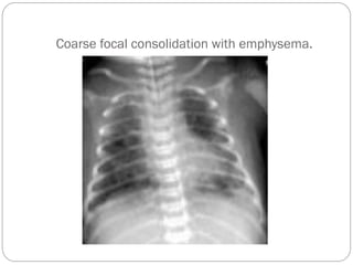 Coarse focal consolidation with emphysema.
 