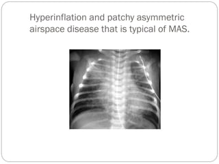 Hyperinflation and patchy asymmetric
airspace disease that is typical of MAS.
 