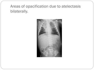 Areas of opacification due to atelectasis
bilaterally.
 