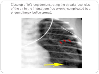 Close up of left lung demonstrating the streaky lucencies
of the air in the interstitium (red arrows) complicated by a
pneumothorax (yellow arrow).
 
