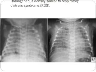 Homogeneous density similar to respiratory
distress syndrome (RDS).
 