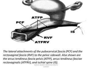 The lateral attachments of the pubocervical fascia (PCF) and the
rectovaginal fascia (RVF) to the pelvic sidewall. Also shown are
the arcus tendineus fascia pelvis (ATFP), arcus tendineus fasciae
rectovaginalis (ATFRV), and ischial spine (IS).
SAMUEL BEZABIH MESKEREM 2004 EC
GONDER
 