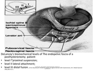 DeLancey's biomechanical levels of The endopelvic fascia of a
posthysterectomy patient
• level I”proximal suspension;
• level II lateral attachment;
• level III distal fusion. (From DeLancey JO. Anatomic aspects of vaginal eversion after hysterectomy. Am J Obstet Gynecol
1992;166:1717.)
SAMUEL BEZABIH MESKEREM 2004 EC
GONDER
 