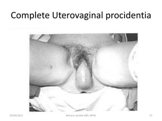 Complete Uterovaginal procidentia
05/04/2012 37
Birhanu sendek (MD, MPH)
 
