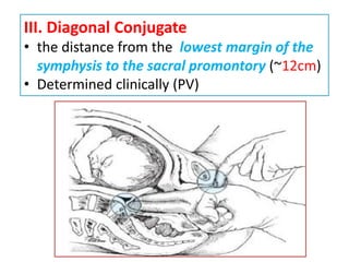 III. Diagonal Conjugate
• the distance from the lowest margin of the
symphysis to the sacral promontory (~12cm)
• Determined clinically (PV)
 