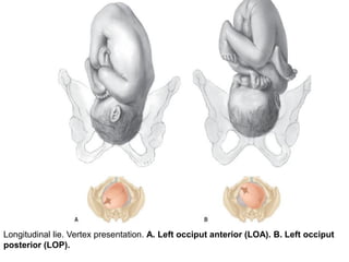 Longitudinal lie. Vertex presentation. A. Left occiput anterior (LOA). B. Left occiput
posterior (LOP).
 