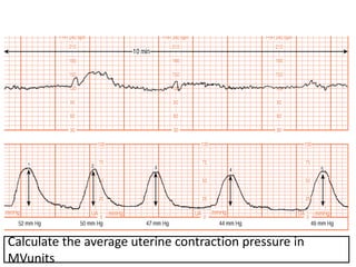 Calculate the average uterine contraction pressure in
MVunits
 