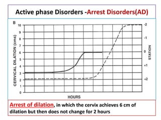 Active phase Disorders -Arrest Disorders(AD)
Arrest of dilation, in which the cervix achieves 6 cm of
dilation but then does not change for 2 hours
 