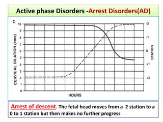 Active phase Disorders -Arrest Disorders(AD)
Arrest of descent. The fetal head moves from a 2 station to a
0 to 1 station but then makes no further progress
 