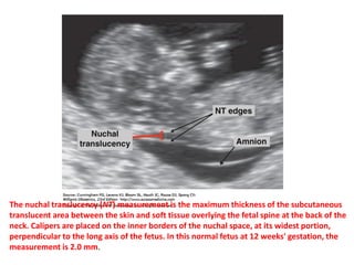 The nuchal translucency (NT) measurement is the maximum thickness of the subcutaneous
translucent area between the skin and soft tissue overlying the fetal spine at the back of the
neck. Calipers are placed on the inner borders of the nuchal space, at its widest portion,
perpendicular to the long axis of the fetus. In this normal fetus at 12 weeks' gestation, the
measurement is 2.0 mm.
 