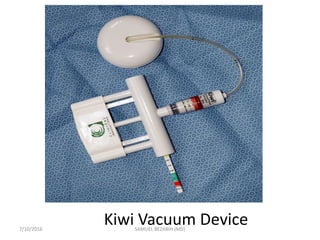 Kiwi Vacuum Device
7/10/2016 SAMUEL BEZABIH (MD)
 