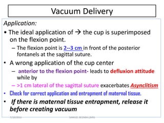 Vacuum Delivery
Application:
• The ideal application of  the cup is superimposed
on the flexion point.
– The flexion point is 2--3 cm in front of the posterior
fontanels at the sagittal suture.
• A wrong application of the cup center
– anterior to the flexion point- leads to defluxion attitude
while by
– >1 cm lateral of the sagittal suture exacerbates Asynclitism
• Check for correct application and entrapment of maternal tissue.
• If there is maternal tissue entrapment, release it
before creating vacuum
7/10/2016 SAMUEL BEZABIH (MD)
 