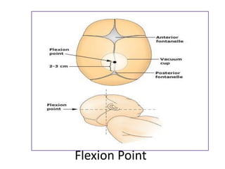Flexion Point
 