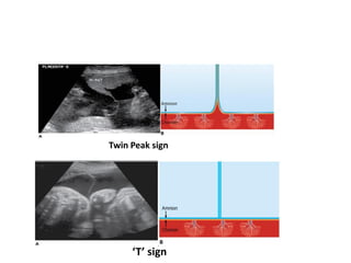 Twin Peak sign
‘T’ sign
 