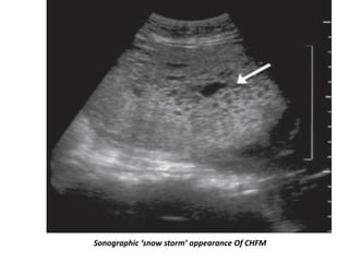 Sonographic ‘snow storm’ appearance Of CHFM
 