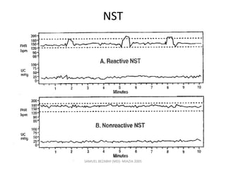 NST
SAMUEL BEZABIH (MD)- MIAZIA 2005
 