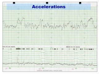 Accelerations
SAMUEL BEZABIH (MD)- MIAZIA 2005
 