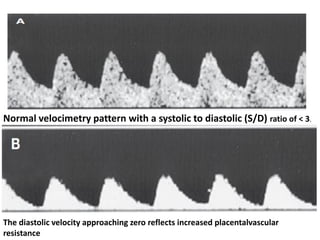 Normal velocimetry pattern with a systolic to diastolic (S/D) ratio of < 3.
The diastolic velocity approaching zero reflects increased placentalvascular
resistance
 