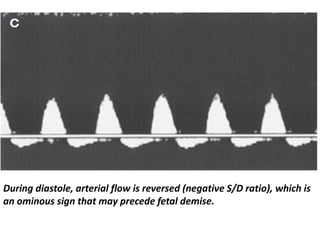 During diastole, arterial flow is reversed (negative S/D ratio), which is
an ominous sign that may precede fetal demise.
 