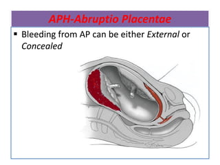APH-Abruptio Placentae
 Bleeding from AP can be either External or
Concealed
 