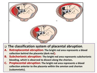  The classification system of placental abruption.
A. Retroplacental abruption: The bright red area represents a blood
collection behind the placenta (dark red).
B. Subchorionic abruption: The bright red area represents subchorionic
bleeding, which is observed to dissect along the chorion.
C. Preplacental abruption: The bright red area represents a blood
collection anterior to the placenta within the amnion and chorion
(subamniotic).
 