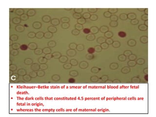  Kleihauer–Betke stain of a smear of maternal blood after fetal
death.
 The dark cells that constituted 4.5 percent of peripheral cells are
fetal in origin,
 whereas the empty cells are of maternal origin.
 