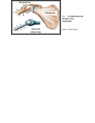 3.4 GAMBAR RAJAH
SENDI YANG
TERLIBAT
Sendi : Sendi lesung
 