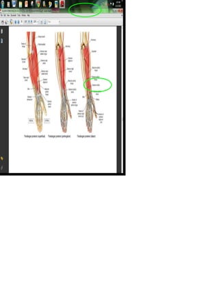 Otot : Biseps Brakil, Ekstensor Digitorium
 