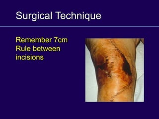 Surgical Technique
Remember 7cm
Rule between
incisions
 