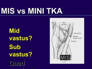 MIS vs MINI TKA
Mid
vastus?
Sub
vastus?
Quad
MIS
 