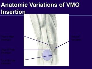 Area of
Variation
Type I-High
Insertion
Type II-Pole
Insertion
Type III-Low
Insertion
Anatomic Variations of VMO
Insertion
 