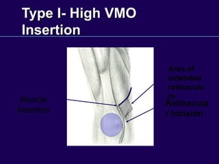 Type I- High VMO
Insertion
Retinacula
r Incision
Area of
extended
retinaculu
m
Muscle
Insertion
 