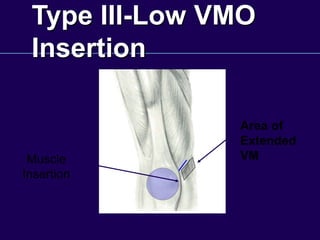 Type III-Low VMO
Insertion
Area of
Extended
VM
Muscle
Insertion
 