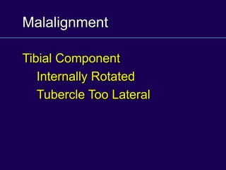 Malalignment
Tibial Component
Internally Rotated
Tubercle Too Lateral
 