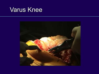 Varus Knee
 