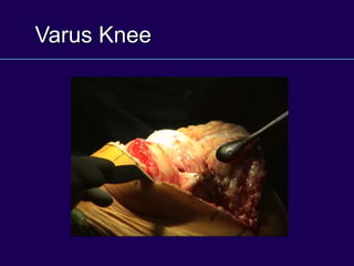 Varus Knee
 