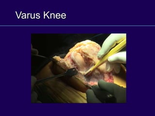 Varus Knee
 