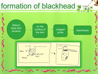 formation of blackhead
Sebum
dead skin
bacteria
on the
surface of
the skin
clogged
pores
blackheads