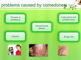 problems caused by comedones
Large pores and
purulent acne
The lack of
confidence
reduced facial
beauty
infection
Rough skin