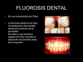 FLUOROSIS DENTAL Es una intoxicación por Flúor. La fluorosis dental es la hipo mineralización del esmalte dental por aumento de la porosidad.  Se debe a una excesiva ingesta de Flúor durante el desarrollo del esmalte antes de la erupción.  