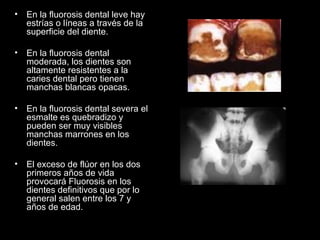 En la fluorosis dental leve hay estrías o líneas a través de la superficie del diente.  En la fluorosis dental moderada, los dientes son altamente resistentes a la caries dental pero tienen manchas blancas opacas.  En la fluorosis dental severa el esmalte es quebradizo y pueden ser muy visibles manchas marrones en los dientes.  El exceso de flúor en los dos primeros años de vida provocará Fluorosis en los dientes definitivos que por lo general salen entre los 7 y años de edad. 