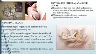 PUDENDAL BLOCK
The stretching of vagina and perineum by the
descending fetal presenting part .
The pain of the second stage of labour is mediated
through the pudendal nerve. The sacral roots 2, 3, 4
and 9 (via the pudendal nerve) provides sensory and
motor innervation to the lower vagina, perineum,vulva
respectively.
During the surgical repair of vaginal and perineal tears
and also episiotomy.
CONTROLLED EPIDURALANALGESIA
(PCEA):
 In control of their own pain relief, and results in
a lower total dose of the local anesthetic used and
less motor blockade.
 This must be combined with a continuous
epidural infusion for best results.
 