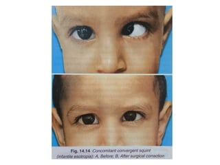 Comitant strabismus.ophthalmology.squint.pptx | Eye and Vision ...