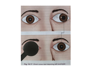 Comitant strabismus.ophthalmology.squint.pptx
