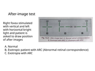 Comitant strabismus.ophthalmology.squint.pptx